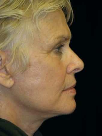 Lower Face lift after 262784