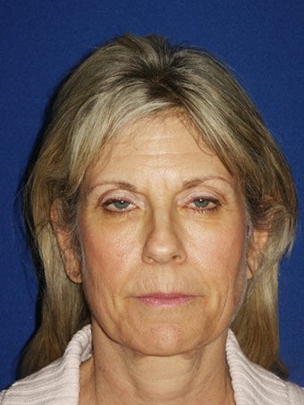 Facelift, Endoscopic Browlift, Upper and Lower Blepharoplasty, Perioral Dermabrasion, Fat injections to the Upper and Lower Lips before 249128