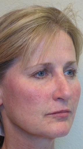 Sculptra and juvederm after 582244