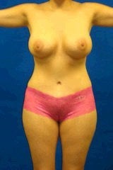 Tummy Tuck (Abdominoplasty), Breast Enhancement after 429758