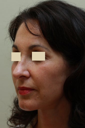 Facelift after 102547