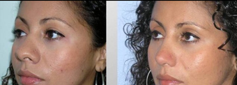 Rhinoplasty before 165807