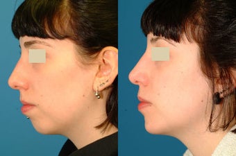Chin Implant before 117340