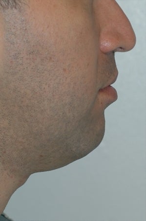 Chin augmentation, neck liposuction and neck muscle tightening. before 277315
