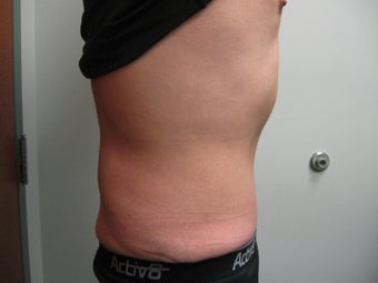 Abdominoplasty on 42 Year Old Male 340025