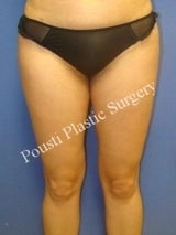 Liposuction after 632100
