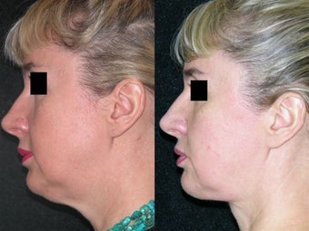 Neck Lipectomy before 143598
