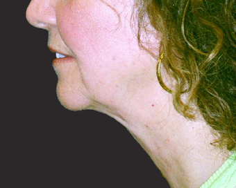 Neck Lift after 229650