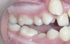 Damon Braces 379871