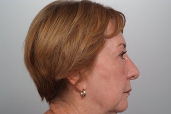 Laser resurfacing for dyschromia (brown spots) after 253091