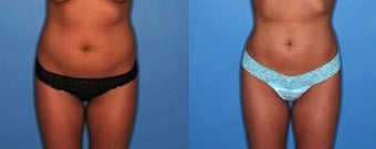 Liposuction - Abdomen and Waist before 131868