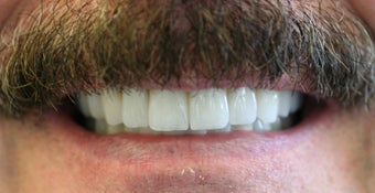 Full mouth rehabilitation using 20 implants to restore 28 teeth after 112629
