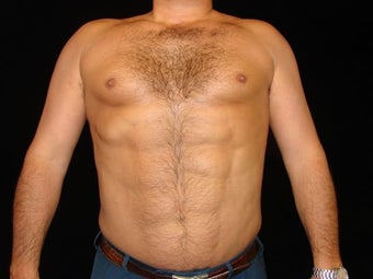 Liposuction of Abdomen, Waist, Flanks, Pecs, and 6 Pack Abdominal Etching after 203543