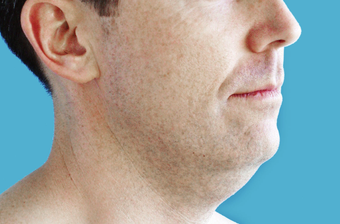 Neck Lift before 229651