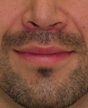 Lip Lift after 635462