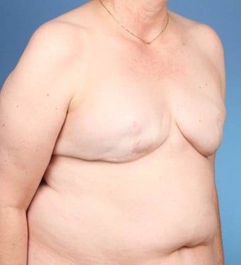 Breast Reconstruction 539979