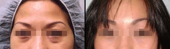 Endoscopic Brow Lift + Lower Eyelid before 649397