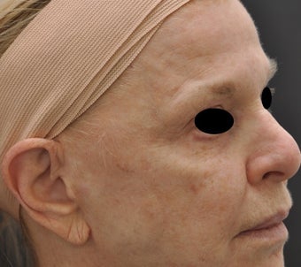 TCA Full-Face Chemical Peel before 182431