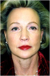 Facelift, Endoscopic Forehead Lift, Quadrilateral Blepharoplasty after 205341