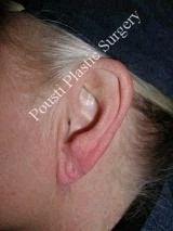 Earlobe Repair Surgery before 612308
