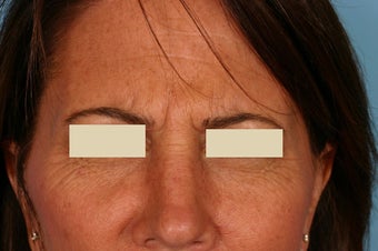 Frown lines treatment before 88694