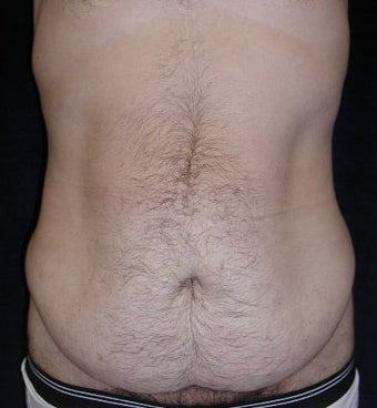 Male tummy Tuck before 578190