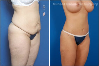 Mommy Makeover: Breast Implants & Tummy Tuck before 255534