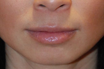 Lip Augmentation after 199331