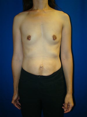 Breast Augmentation Surgery before 159288