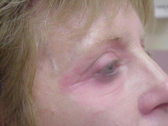 Eyelid surgery with CO2 laser resurfacing after 140083