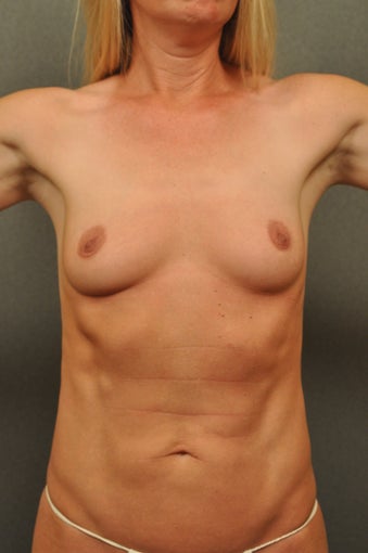 Reverse Abdominoplasty before 551401