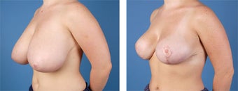 Breast Reduction 355748