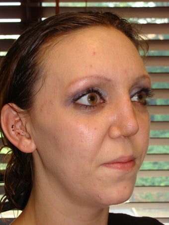 Rhinoplasty 368032