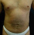 Liposculpture, Liposuction for men before 151083