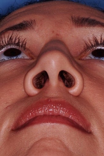 Rhinoplasty before 91602