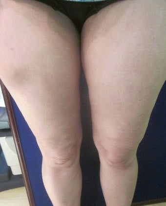 Cellulaze after 589900