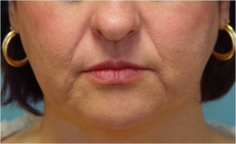 Radiesse injection nasolabial folds and marionette lines before 255551