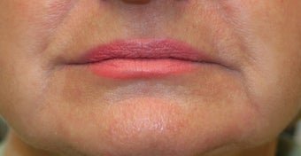 Restylane around the mouth before 240869