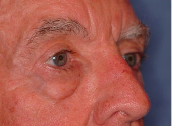 Extended lower lid blepharoplasty 480035