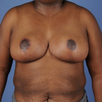 Breast Reduction after 352964