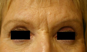 Botox & Restylane - Glabella before 410982