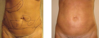 Slim Lipo before 69342