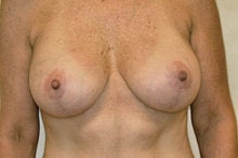 Full Mastopexy Breast Augmentation after 244755