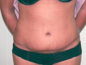Abdominoplasty after 238220