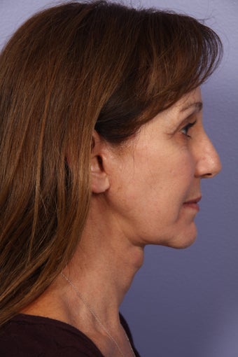 53 yr old Face and Necklift 622095