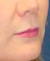 Lip Augmentation with lip lift 99429
