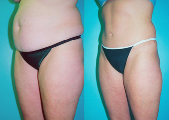 Tummy Tuck with Liposuction before 259567
