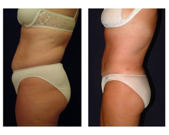 Tummy Tuck / Abdominoplasty before 55009