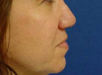 Rhinoplasty 321766
