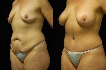 Tummy Tuck and Breast Augmentation, gel implants after 392054